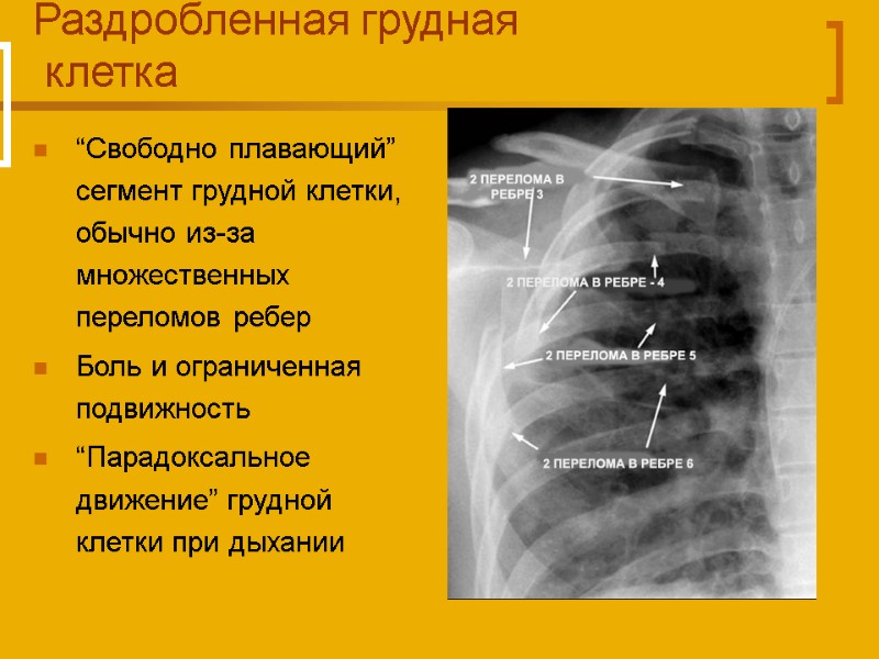 Раздробленная грудная  клетка “Свободно плавающий” сегмент грудной клетки, обычно из-за множественных переломов ребер